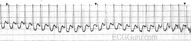 PSVT | ECG Guru - Instructor Resources